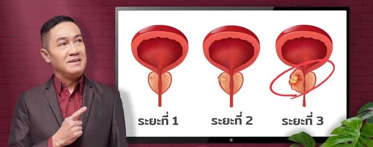 วิธีการทาน P-FLOW ให้เหมาะกับแต่ละระยะอาการ