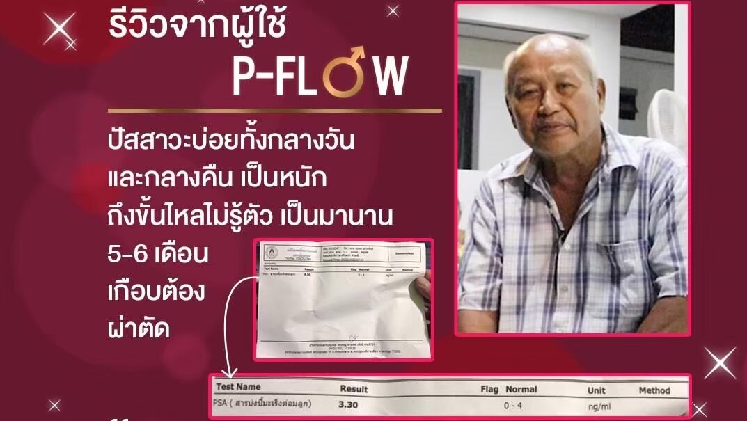 รีวิวผู้ใช้ P-FLOW ที่ไม่ต้องผ่าตัด